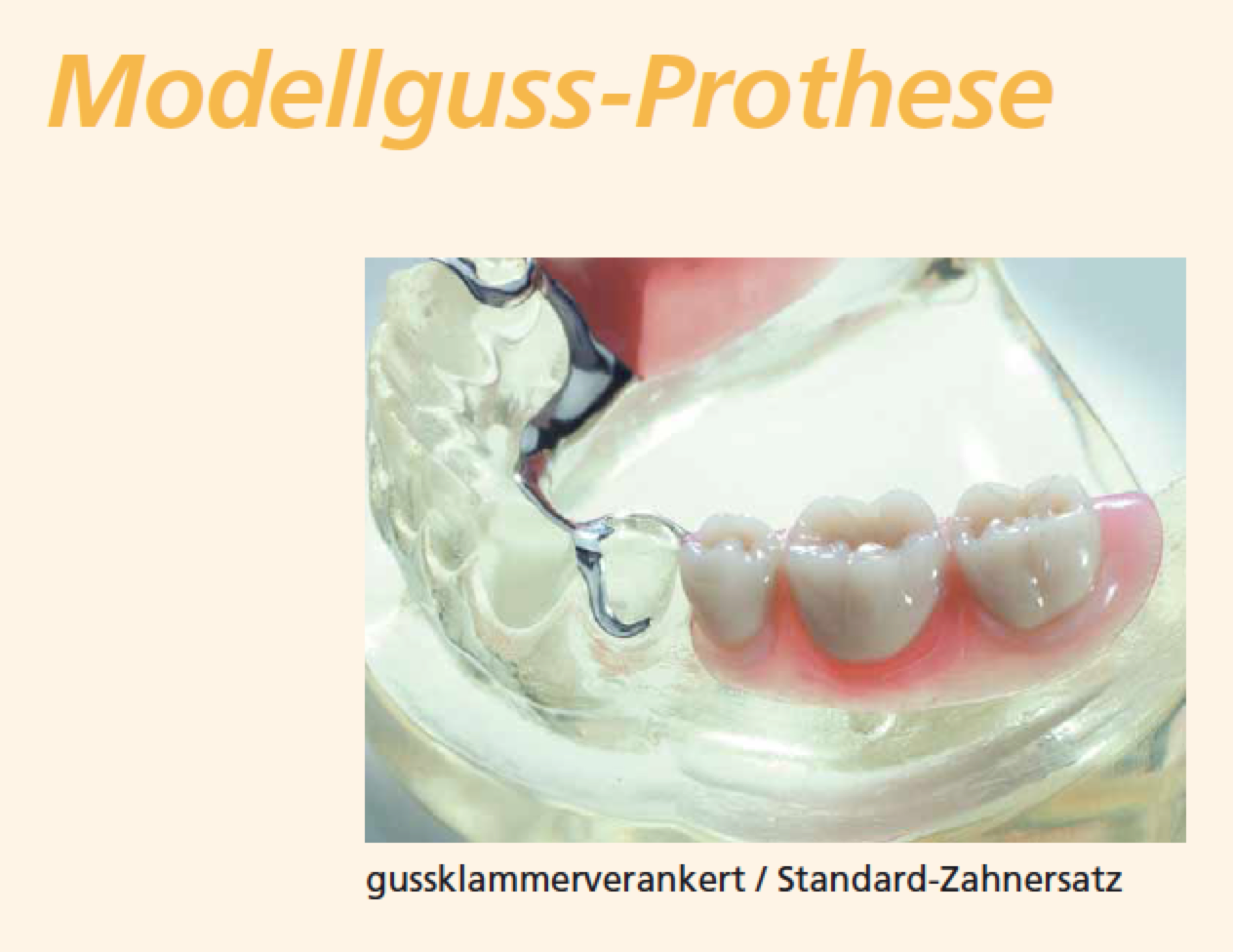 Modellguß: Klammerprothese